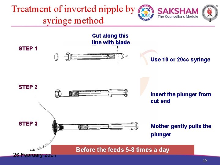 Treatment of inverted nipple by syringe method Cut along this line with blade STEP
