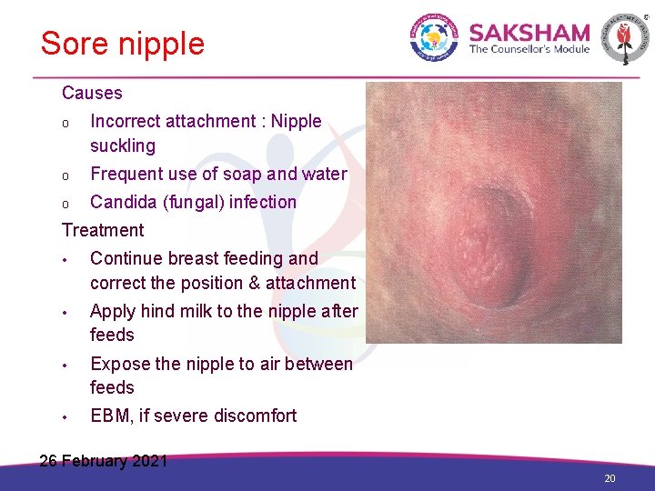 Sore nipple Causes o Incorrect attachment : Nipple suckling o Frequent use of soap