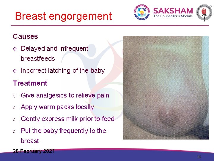 Breast engorgement Causes v Delayed and infrequent breastfeeds v Incorrect latching of the baby