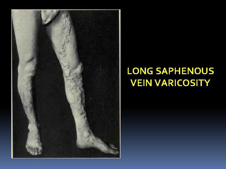 LONG SAPHENOUS VEIN VARICOSITY 