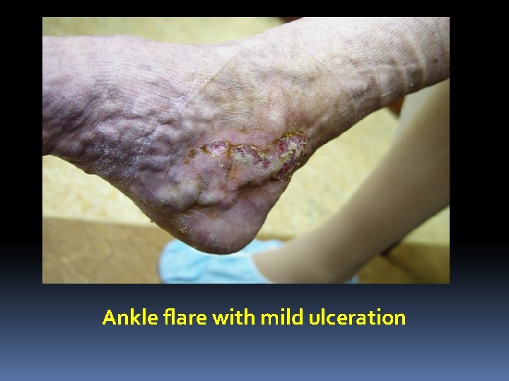 Ankle flare with mild ulceration 