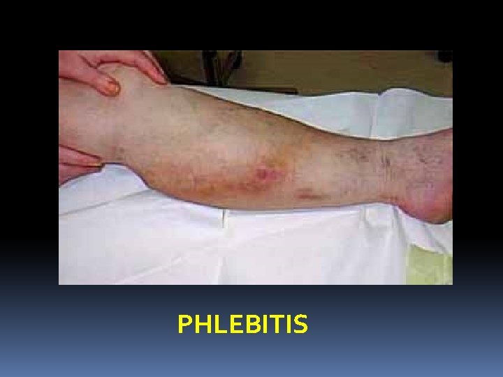 PHLEBITIS 