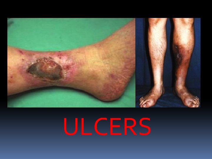 ULCERS 