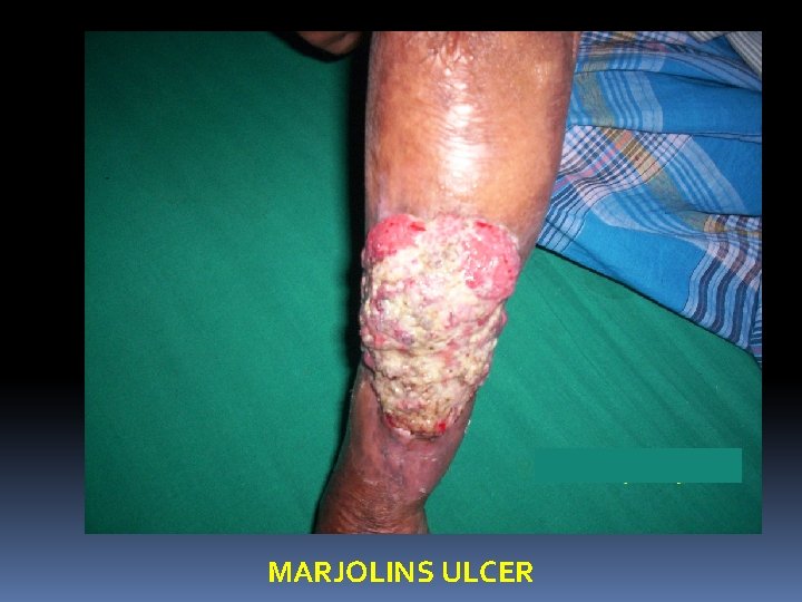 MARJOLINS ULCER 