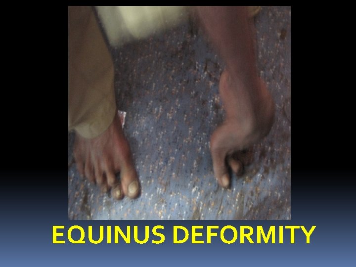 EQUINUS DEFORMITY 