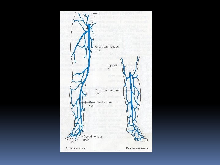 VARICOSE VEINS DEFINITION When a vein dilated