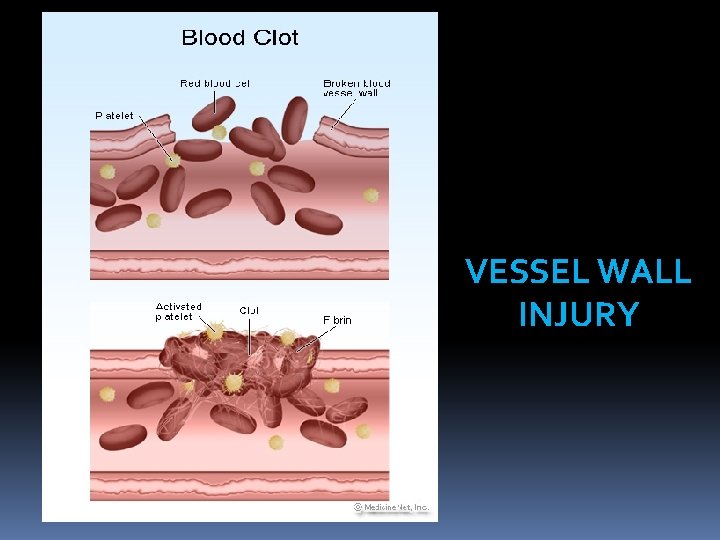 VESSEL WALL INJURY 