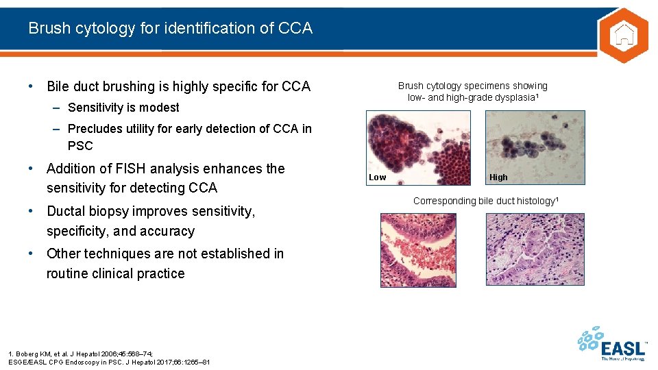 Brush cytology for identification of CCA • Bile duct brushing is highly specific for