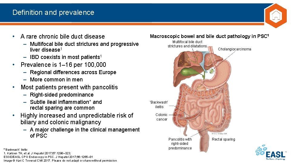 Definition and prevalence • A rare chronic bile duct disease Macroscopic bowel and bile