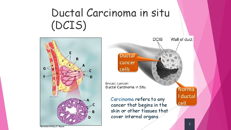 Ductal Carcinoma in situ (DCIS) Ductal cancer cells Carcinoma refers to any cancer that