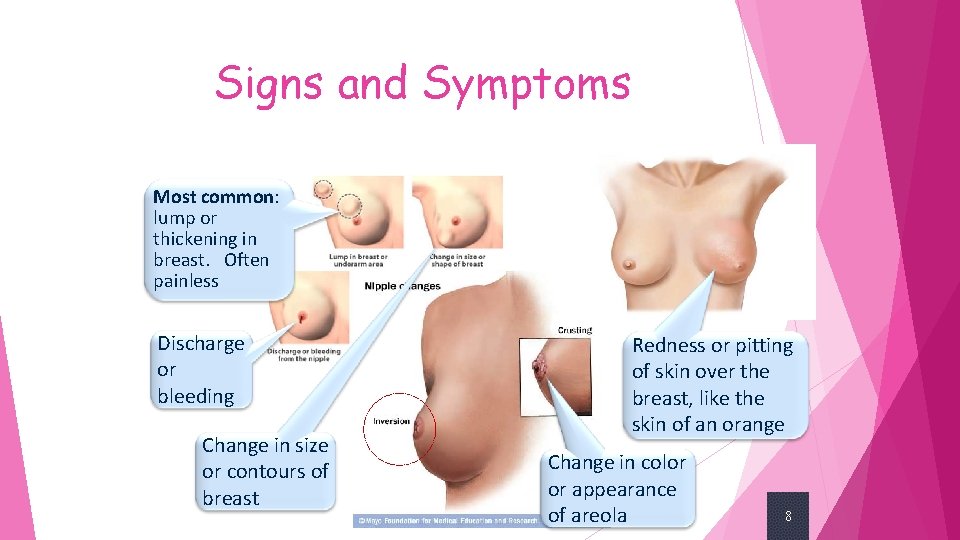 Signs and Symptoms Most common: lump or thickening in breast. Often painless Discharge or