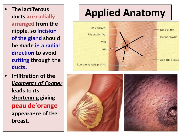 • The lactiferous ducts are radially arranged from the nipple, so incision of