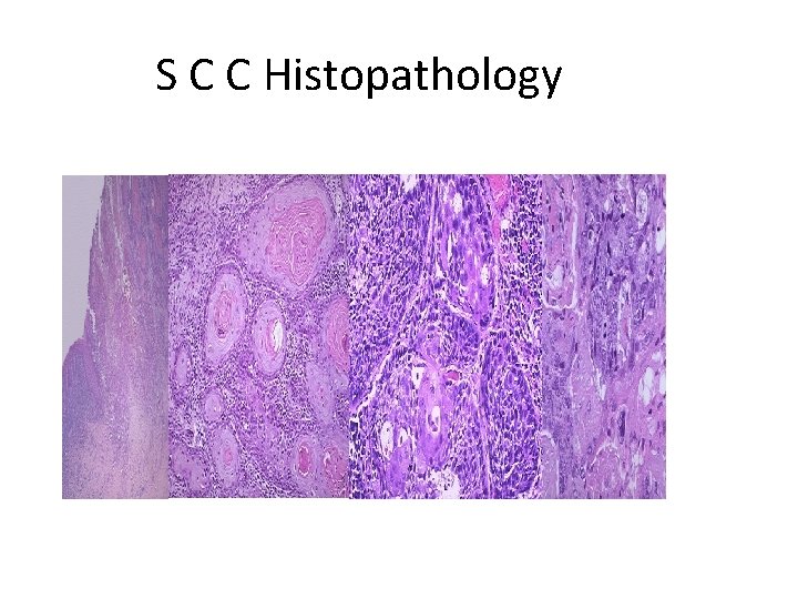 S C C Histopathology 