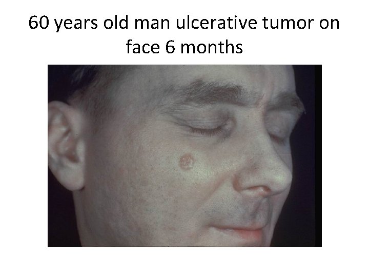 60 years old man ulcerative tumor on face 6 months 