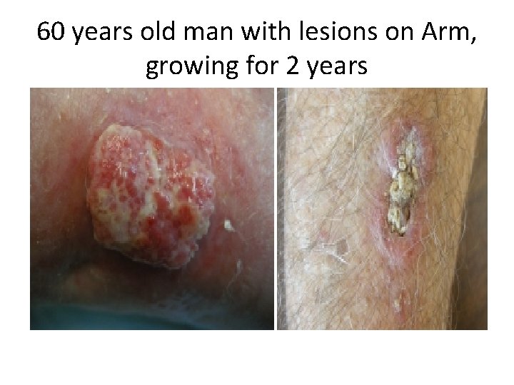 60 years old man with lesions on Arm, growing for 2 years 
