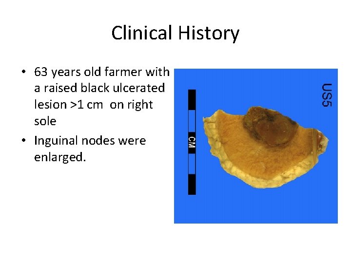 Clinical History • 63 years old farmer with a raised black ulcerated lesion >1