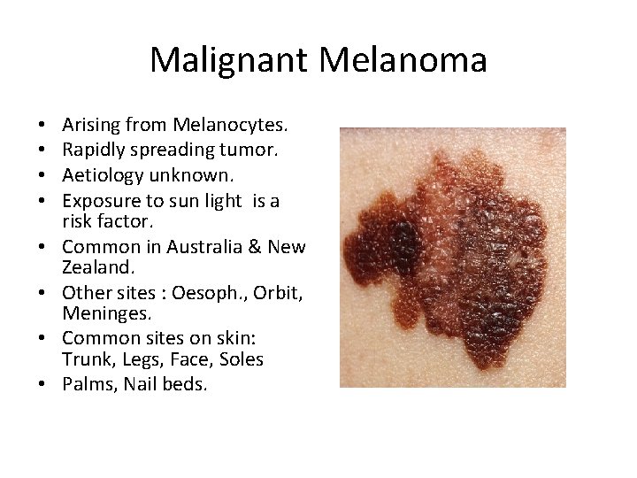 Malignant Melanoma • • Arising from Melanocytes. Rapidly spreading tumor. Aetiology unknown. Exposure to