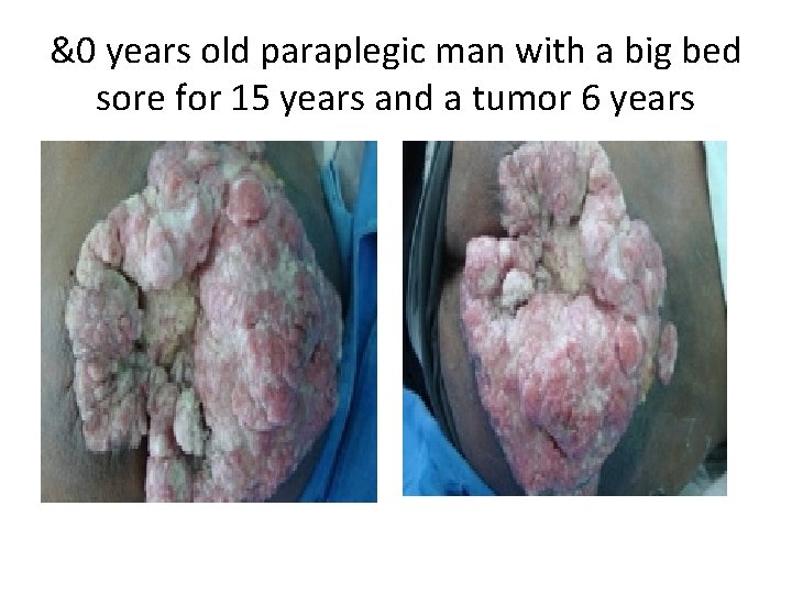 &0 years old paraplegic man with a big bed sore for 15 years and