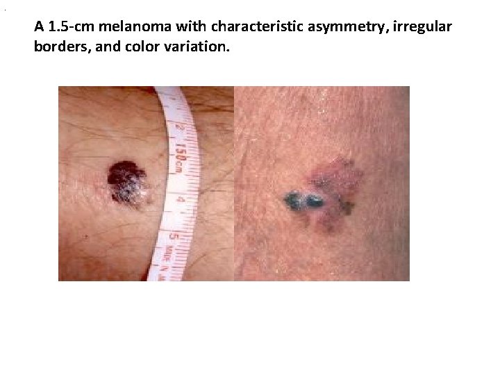 . A 1. 5 -cm melanoma with characteristic asymmetry, irregular borders, and color variation.