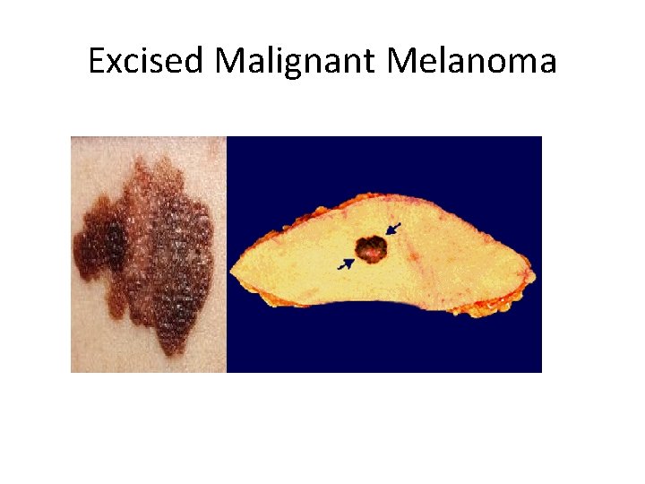 Excised Malignant Melanoma 