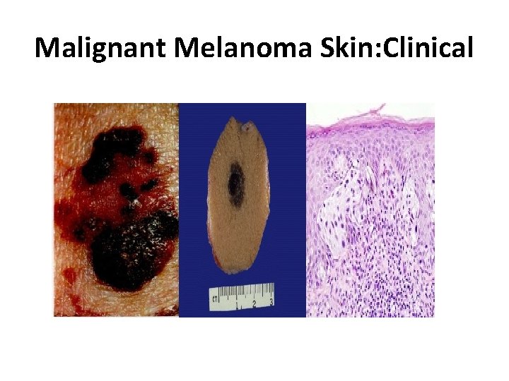 Malignant Melanoma Skin: Clinical 