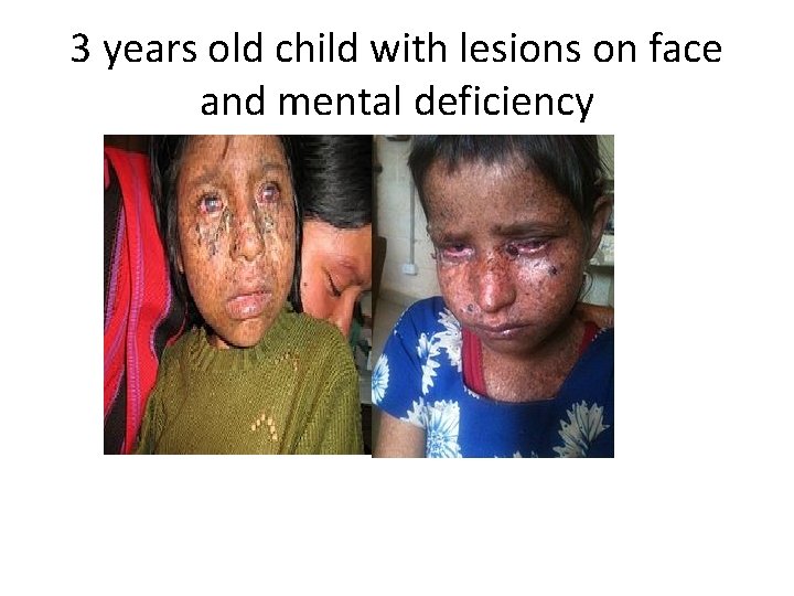 3 years old child with lesions on face and mental deficiency 