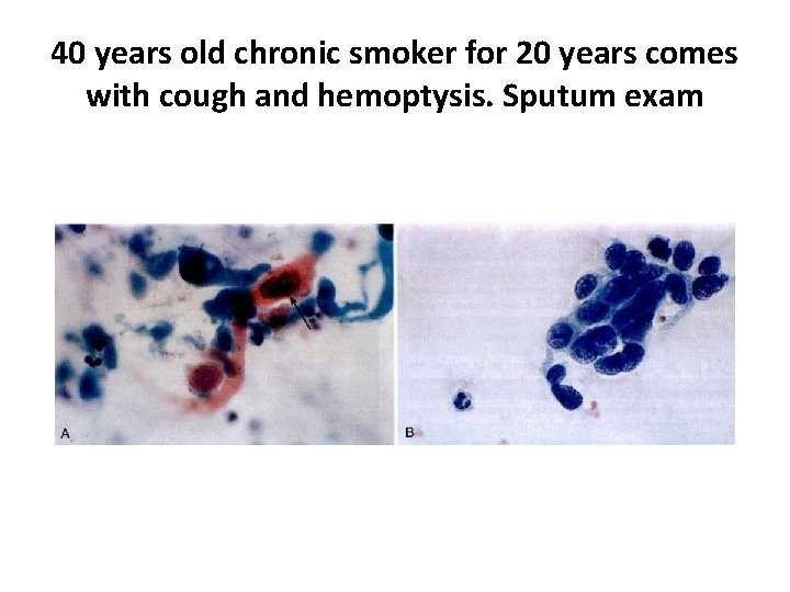 40 years old chronic smoker for 20 years comes with cough and hemoptysis. Sputum