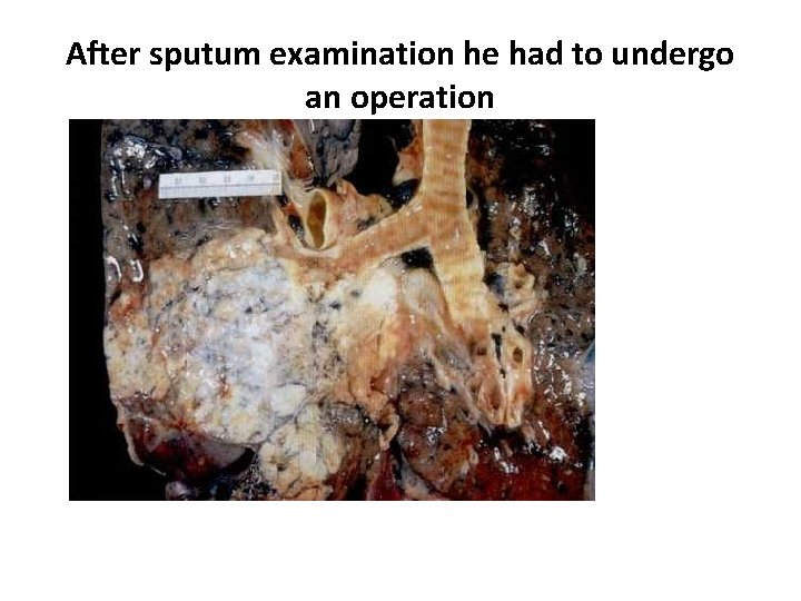 After sputum examination he had to undergo an operation 