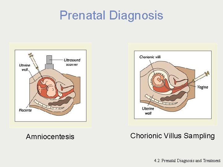 Prenatal Diagnosis Amniocentesis Chorionic Villus Sampling 4. 2: Prenatal Diagnosis and Treatment 
