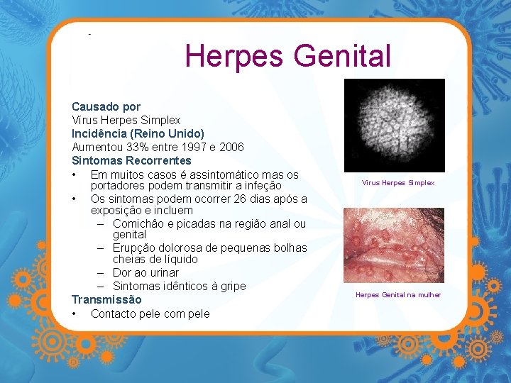 Herpes Genital Causado por Vírus Herpes Simplex Incidência (Reino Unido) Aumentou 33% entre 1997