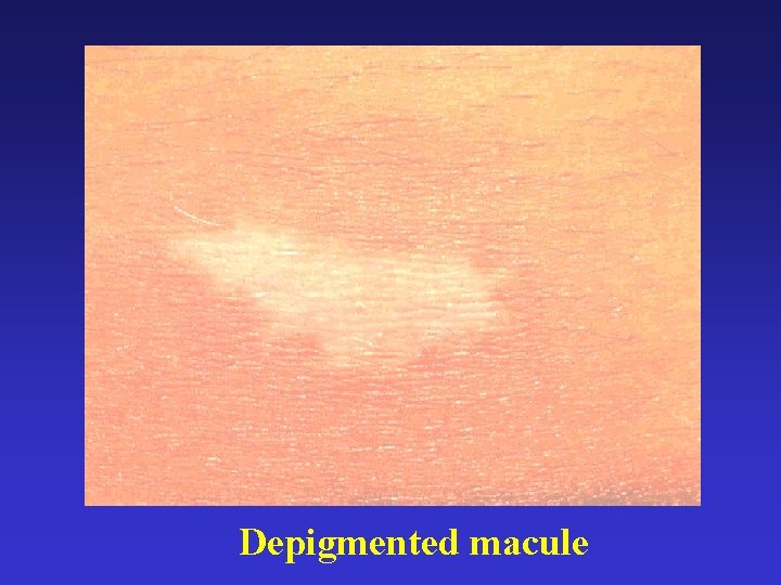 Depigmented macule 