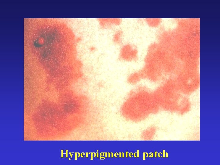 Hyperpigmented patch 