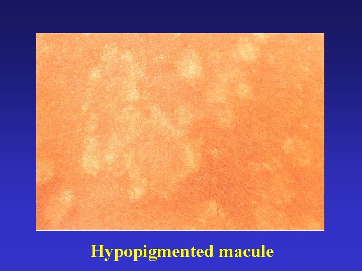 Hypopigmented macule 