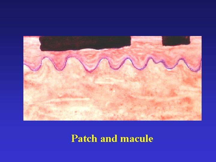 Patch and macule 