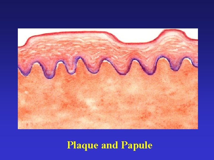 Plaque and Papule Plaque and Papule