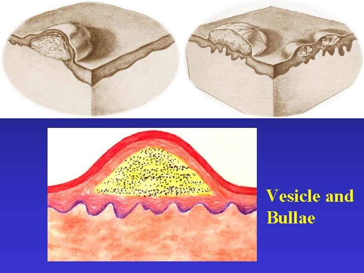 Vesicle and Bullae 