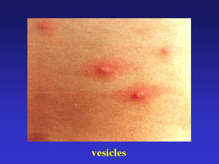 vesicles 