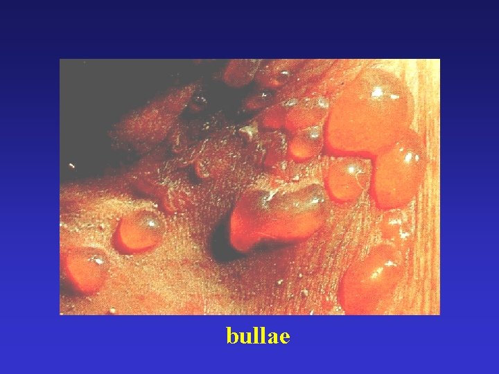 bullae 