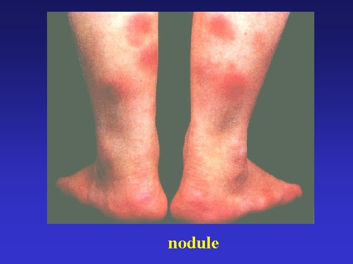 nodule 