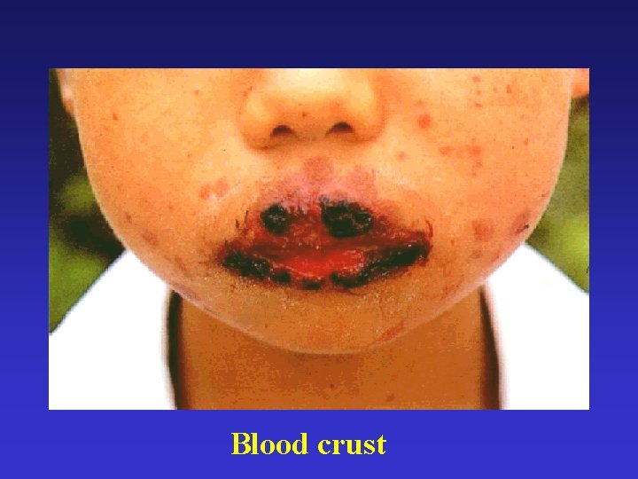 Blood crust 