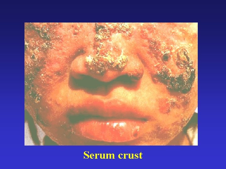 Serum crust 
