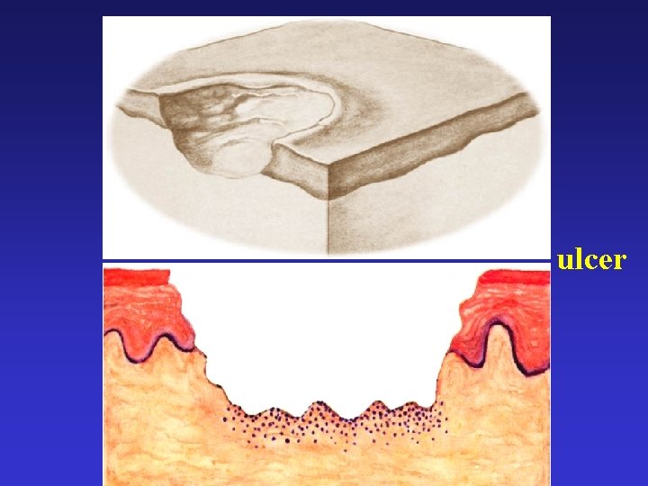 ulcer ulcer
