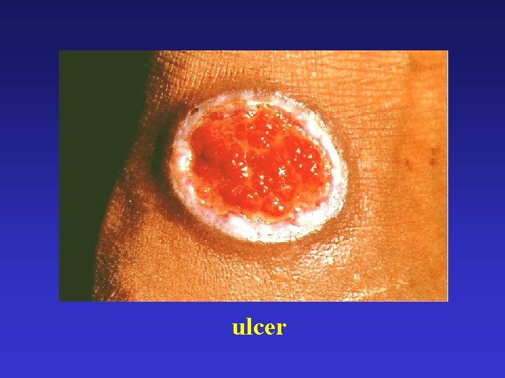 ulcer 