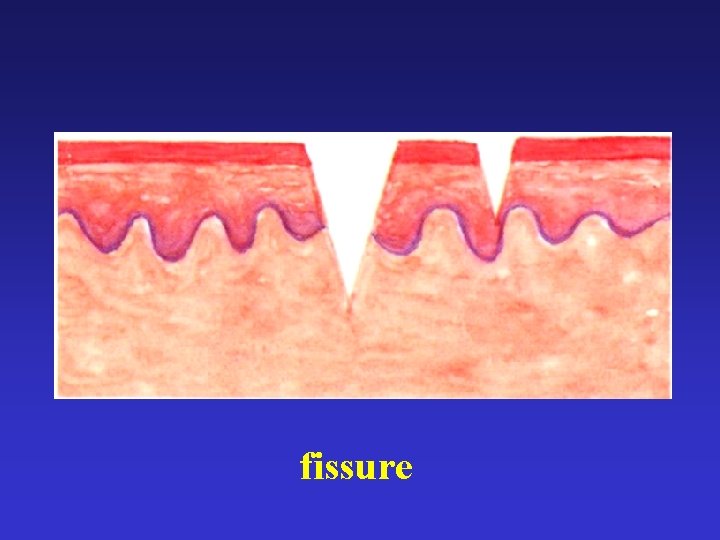 fissure 