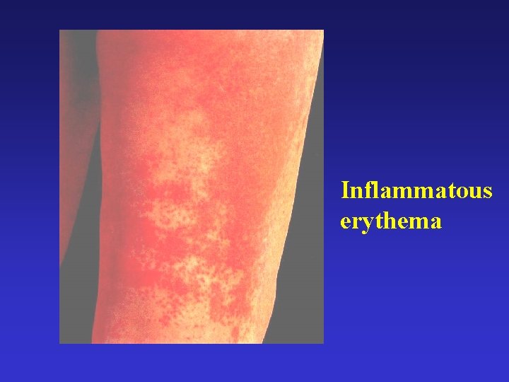 Inflammatous erythema 
