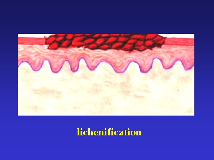 lichenification 