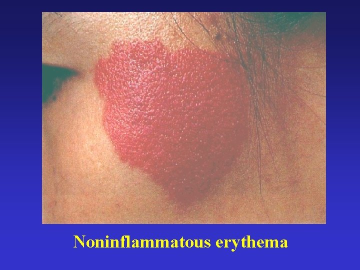 Noninflammatous erythema 