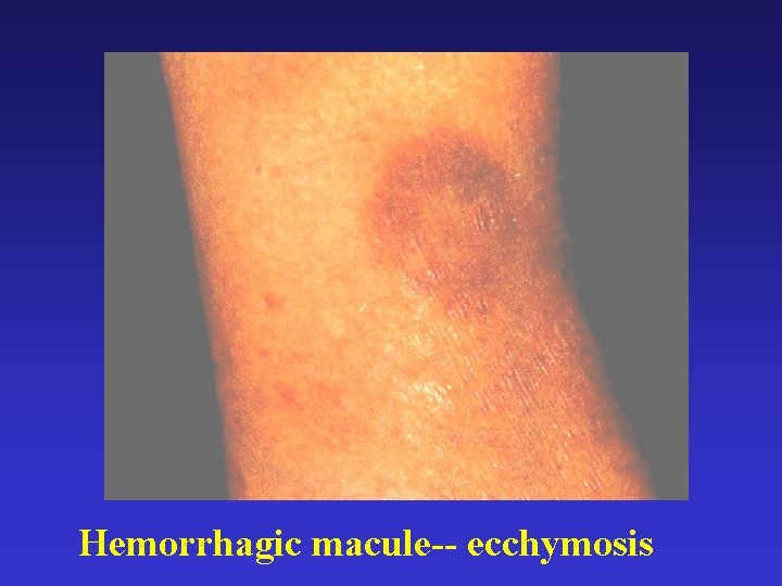 Hemorrhagic macule-- ecchymosis 