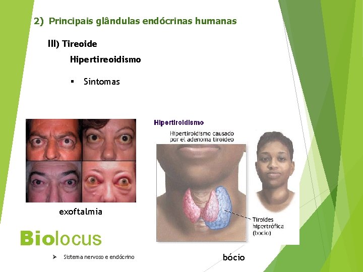 2) Principais glândulas endócrinas humanas III) Tireoide Hipertireoidismo § Sintomas exoftalmia Biolocus Ø Sistema