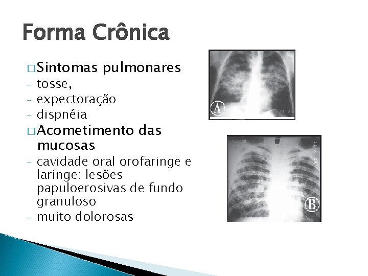 Forma Crônica � Sintomas - pulmonares tosse, expectoração dispnéia � Acometimento mucosas - -